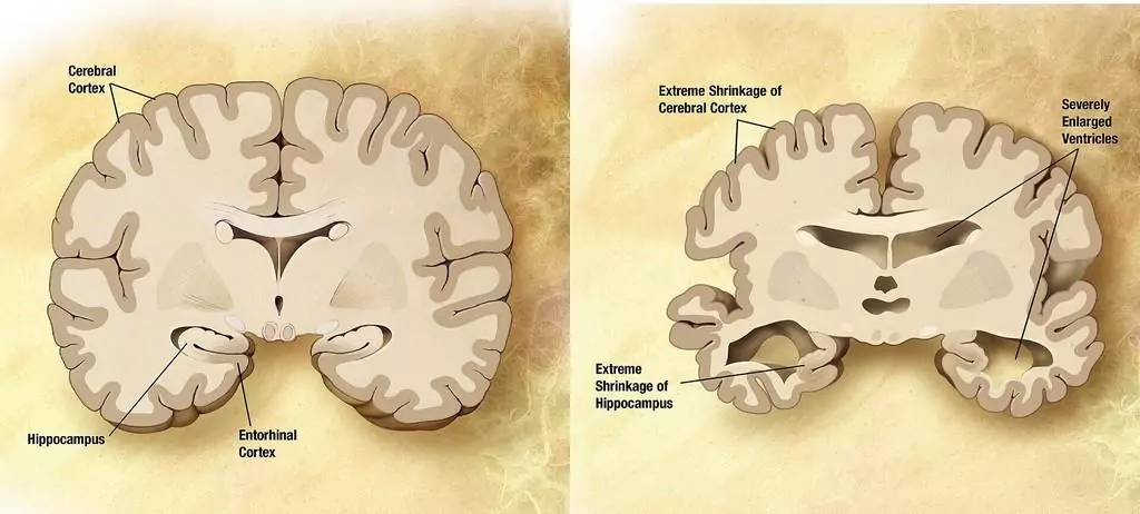 alzheimerova choroba 2024